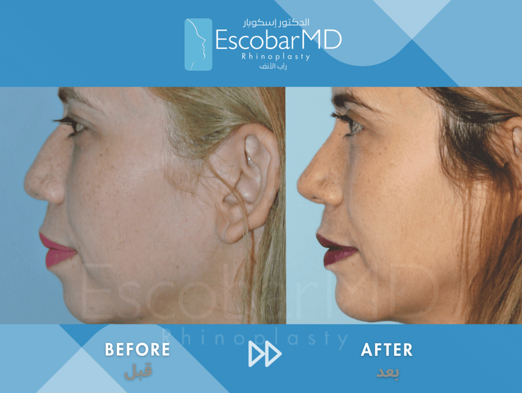 Female Ethnic Rhinoplasty & Chin Implant in Dubai 3 Female Ethnic Rhinoplasty Dr Escobar UAE (3)