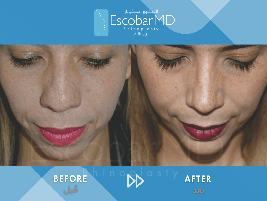 Female Ethnic Rhinoplasty & Chin Implant in Dubai 4 Female Ethnic Rhinoplasty Dr Escobar UAE (4)