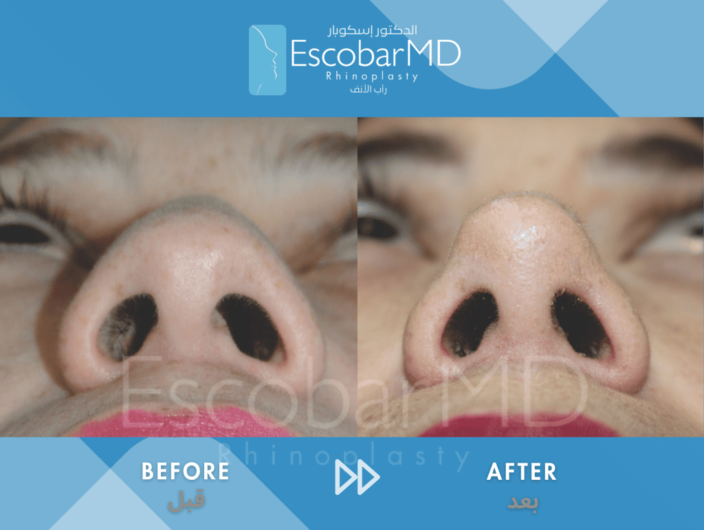 Female Ethnic Rhinoplasty & Chin Implant in Dubai 5 Female Ethnic Rhinoplasty Dr Escobar UAE (5)