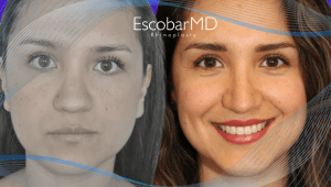 Before After Revision Rhinoplasty in Dubai 9 Female Revision Rhinoplasty Dr Escobar Dubai