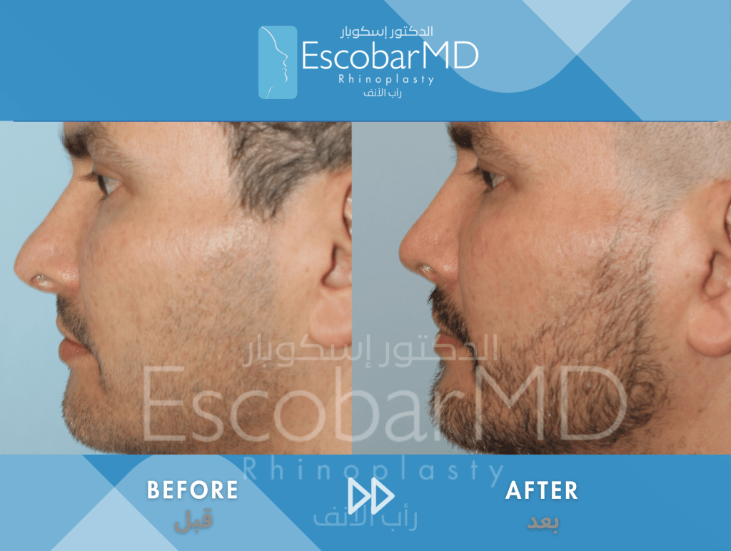 Male Revision Rhinoplasty using Closed Approach in Dubai 3 Male Revision Rhinoplasty Dr Escobar UAE (2)
