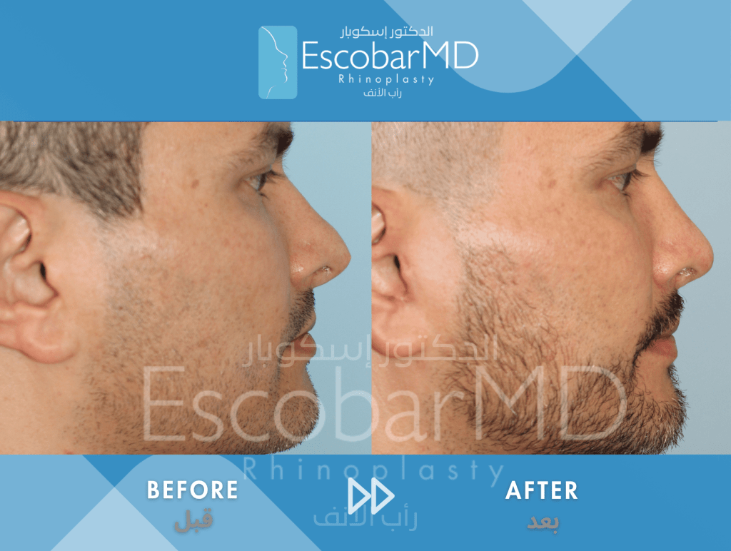 Male Revision Rhinoplasty using Closed Approach in Dubai 5 Male Revision Rhinoplasty Dr Escobar UAE (4)