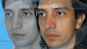 Rhinoplasty in Men Dubai with Dr. Escobar 6 Male Rhinoplasty Dr Escobar Dubai