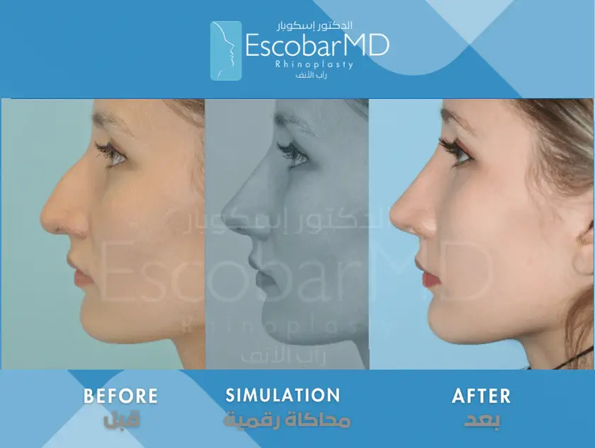 First Rhinoplasty Consultation in Dubai 6 Before, simulation, and after images of a rhinoplasty procedure, showcasing the profile of a woman's nose with noticeable changes.
