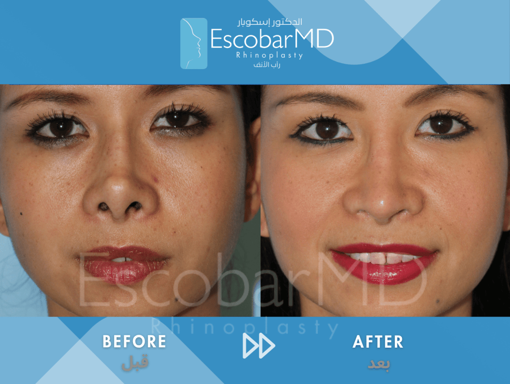 Endonasal Revision Rhinoplasty with Upturned Tip Correction in Dubai 1 Scarless Revision Rhinoplasty Dr Escobar UAE (1)