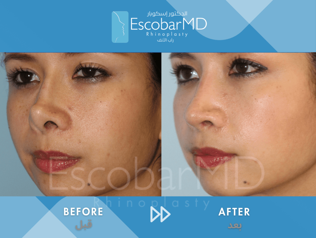 Endonasal Revision Rhinoplasty with Upturned Tip Correction in Dubai 2 Scarless Revision Rhinoplasty Dr Escobar UAE (2)