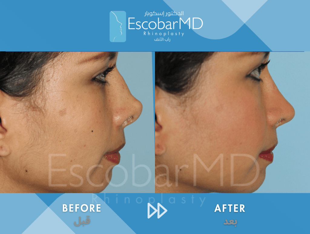 Endonasal Revision Rhinoplasty with Upturned Tip Correction in Dubai 3 Scarless Revision Rhinoplasty Dr Escobar UAE (3)
