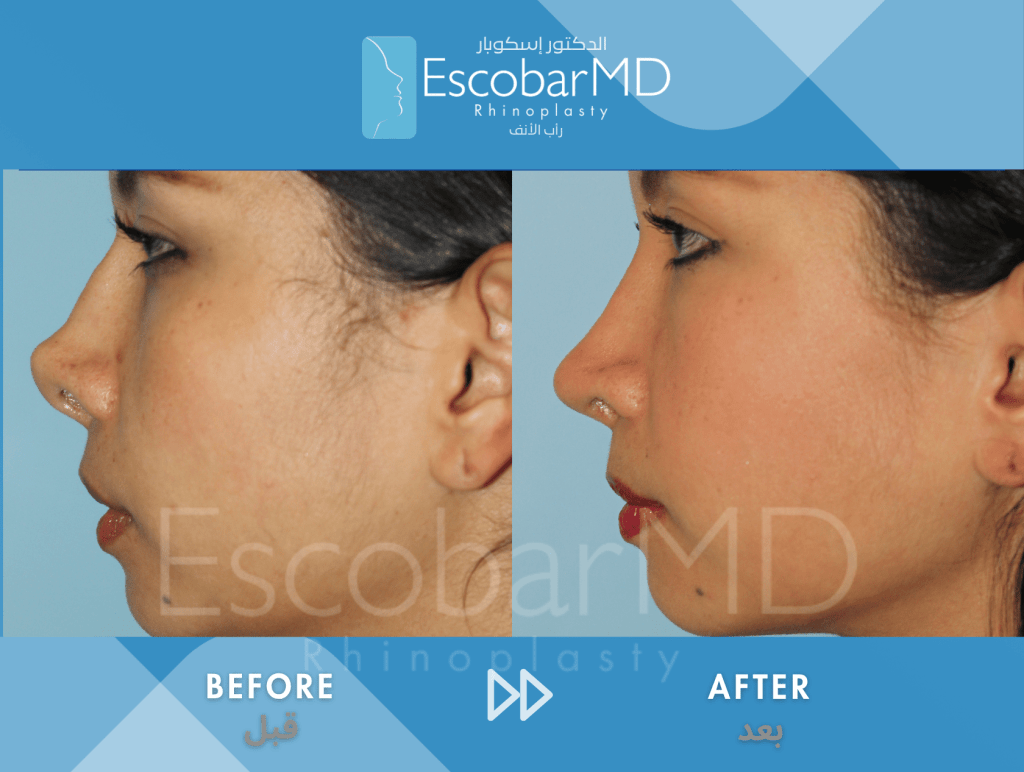 Endonasal Revision Rhinoplasty with Upturned Tip Correction in Dubai 4 Scarless Revision Rhinoplasty Dr Escobar UAE (4)
