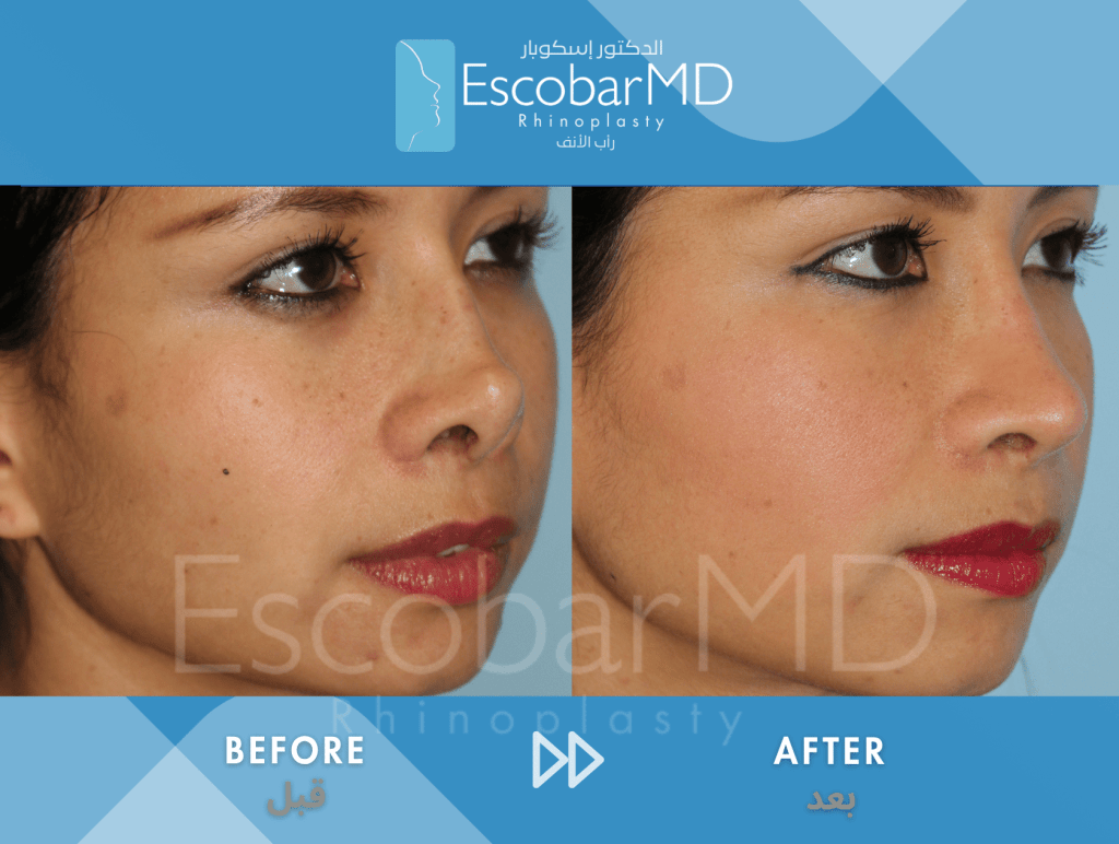 Endonasal Revision Rhinoplasty with Upturned Tip Correction in Dubai 5 Scarless Revision Rhinoplasty Dr Escobar UAE (5)
