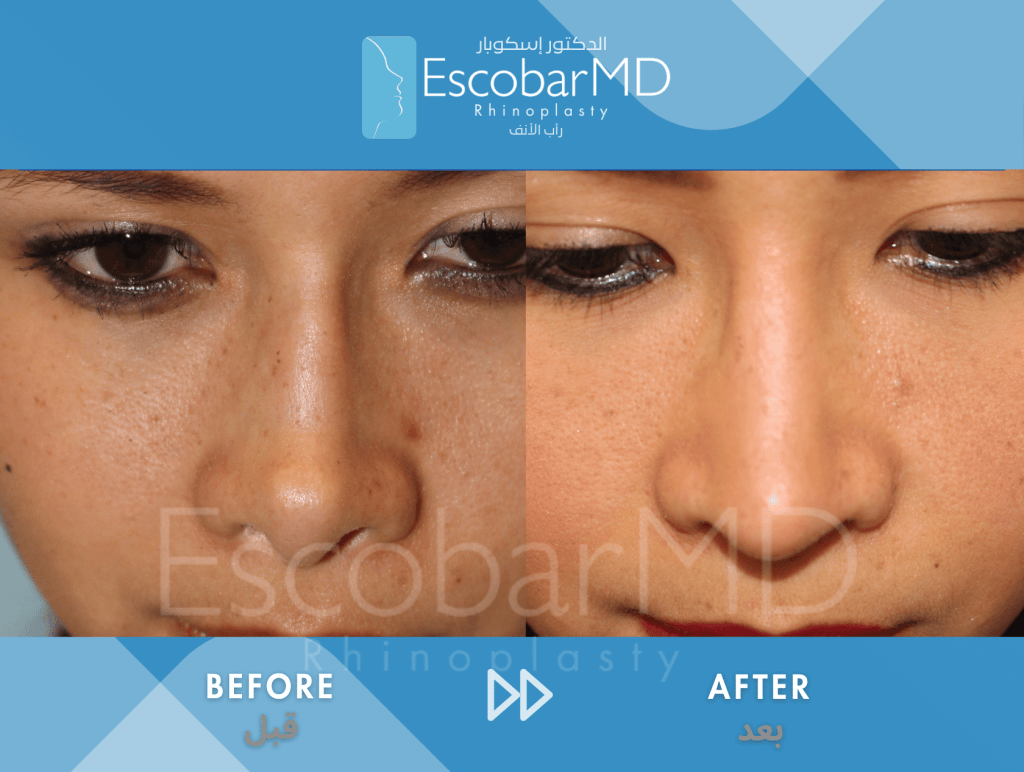 Endonasal Revision Rhinoplasty with Upturned Tip Correction in Dubai 6 Scarless Revision Rhinoplasty Dr Escobar UAE (6)