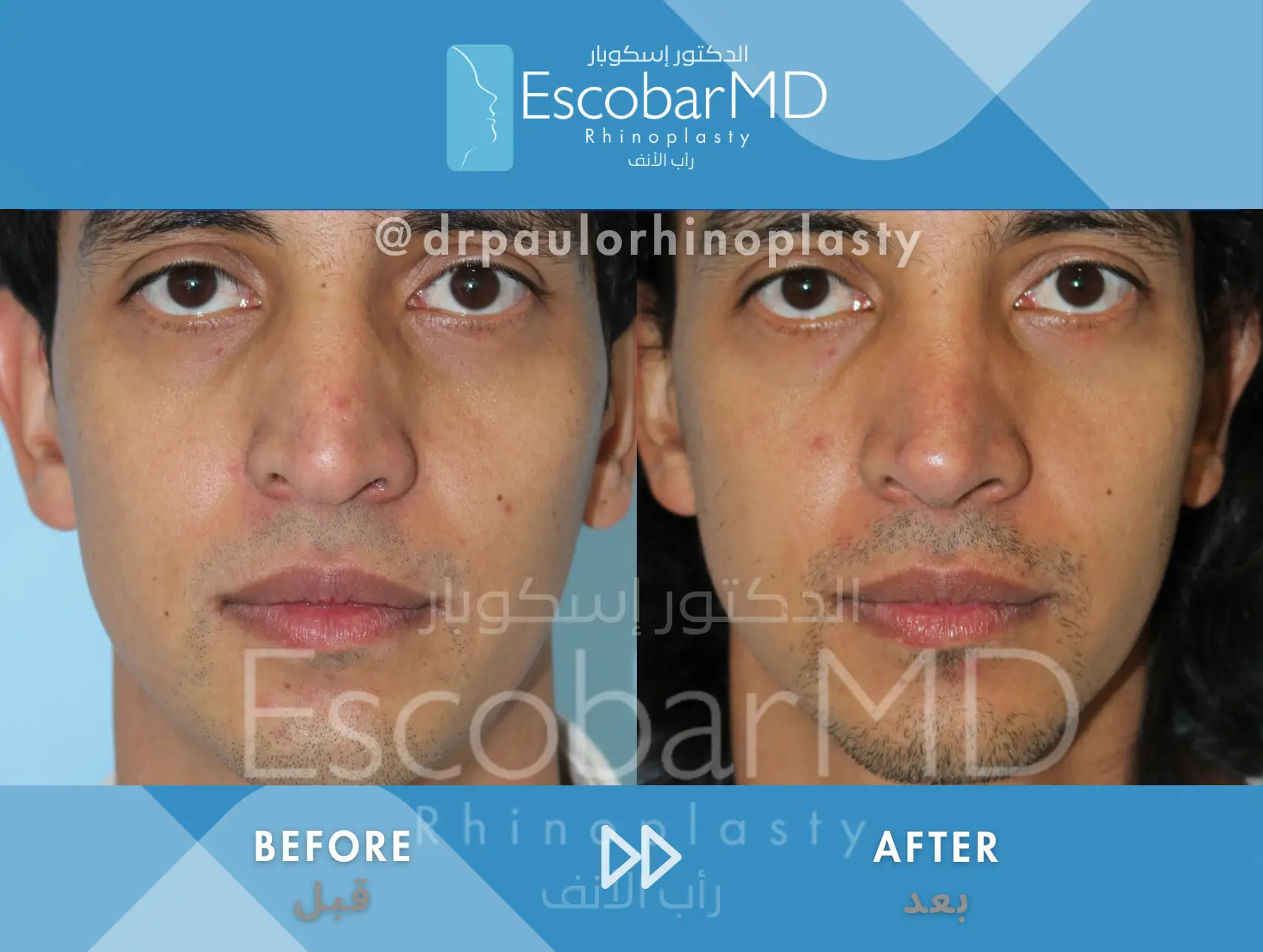 Structural Rhinoplasty in Men – Closed Male Rhinoplasty in Dubai 5 Structural Rhinoplasty in Men | Abu Dhabi | Dubai