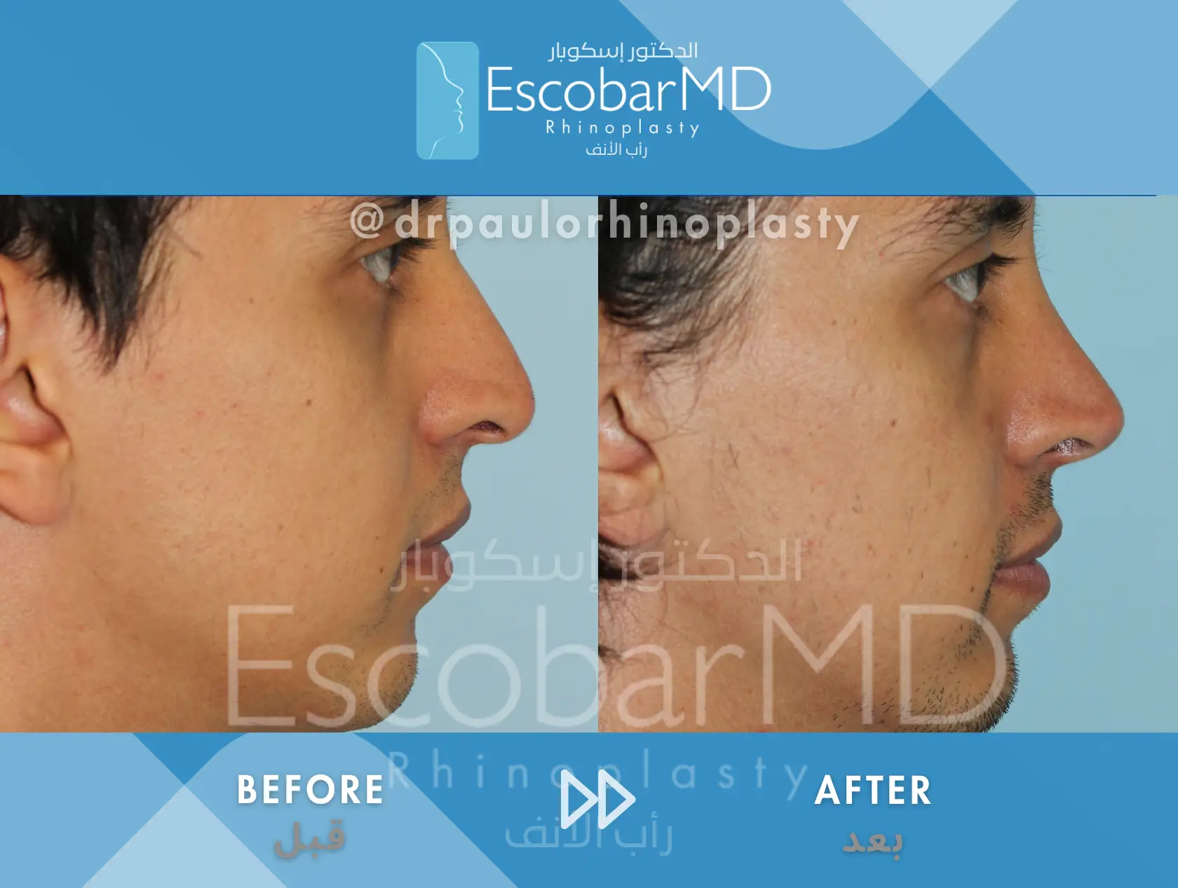 Structural Rhinoplasty in Men – Closed Male Rhinoplasty in Dubai 3 before after male rhinoplasty