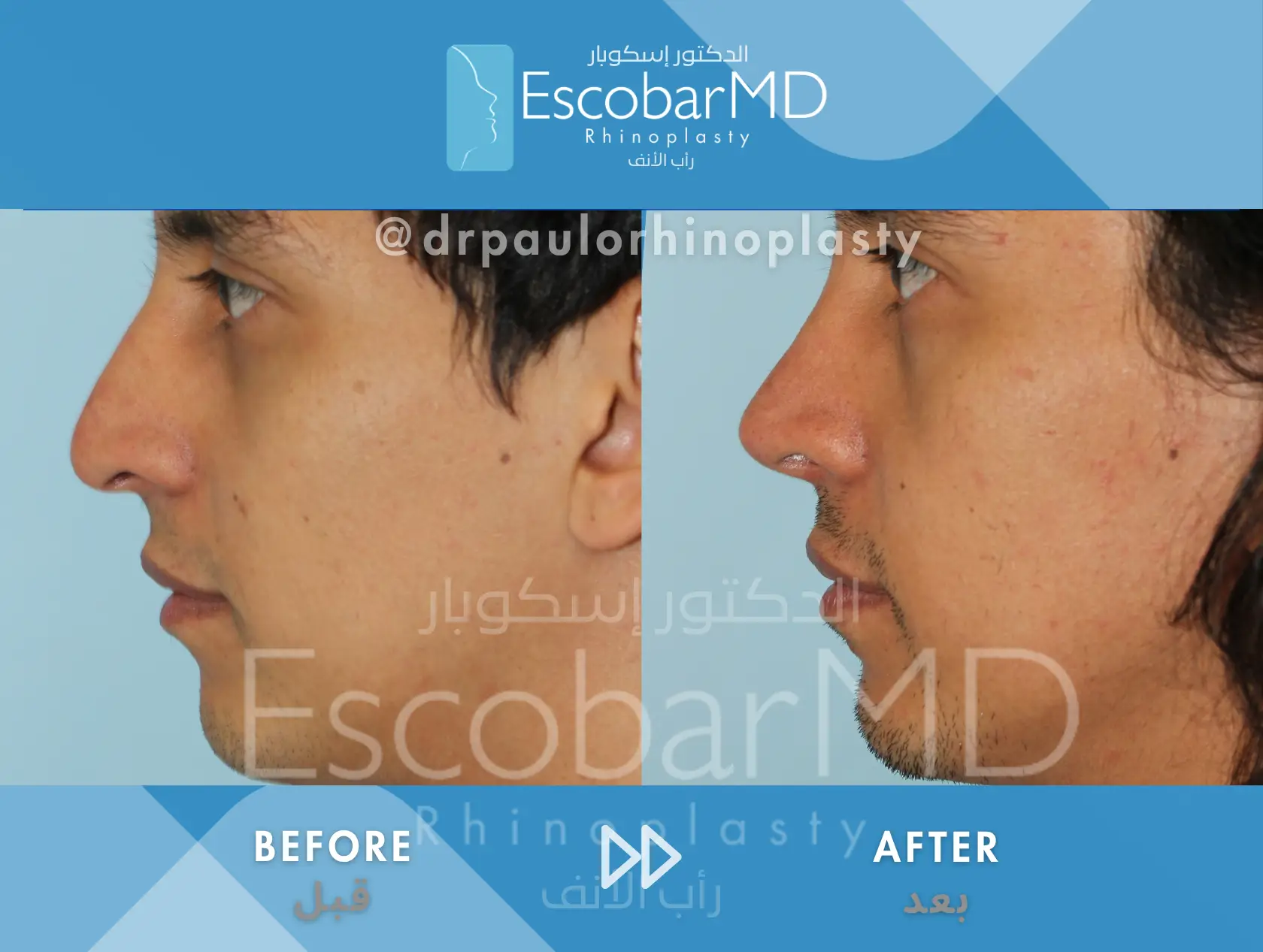 Structural Rhinoplasty in Men – Closed Male Rhinoplasty in Dubai 2 before after male rhinoplasty