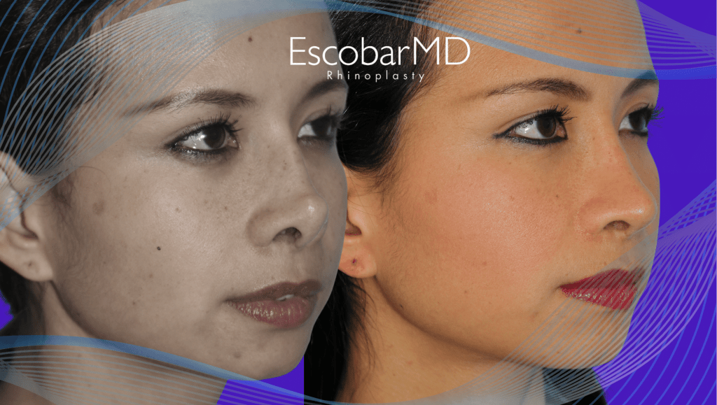 Revision Rhinoplasty in Dubai with Dr. Escobar 4 Closed Revision Rhinoplasty Dr Paulo A Escobar Abu Dhabi Dubai