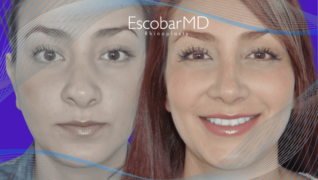 Revision Rhinoplasty in Dubai with Dr. Escobar 5 Endonasal Revision Rhinoplasty Dr Escobar Abu Dhabi Dubai