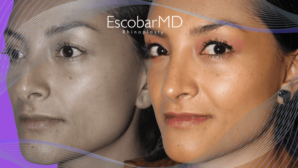 Escobar MD | Best Scarless Rhinoplasty in Dubai 8 closed rhinoplasty before after Abu Dhabi Dubai