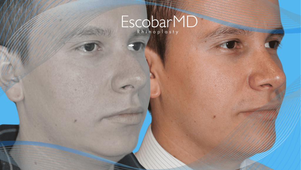 Escobar MD | Best Scarless Rhinoplasty in Dubai 4 Male Rhinoplasty Dr Escobar Abu Dhabi Dubai