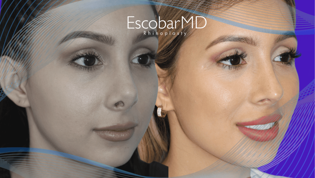Escobar MD | Best Scarless Rhinoplasty in Dubai 7 revision rhinoplasty Abu Dhabi Dubai