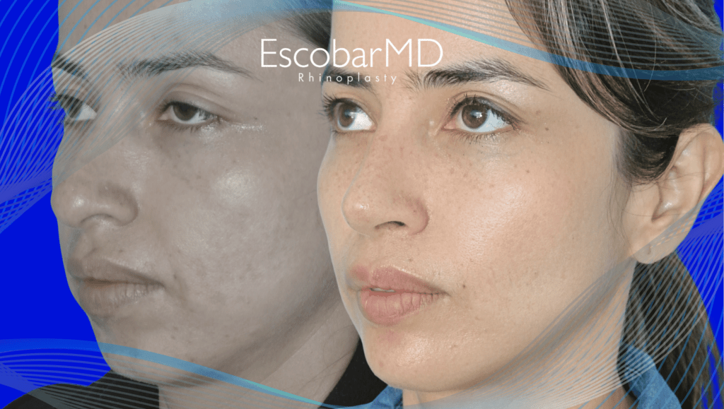 Escobar MD | Best Scarless Rhinoplasty in Dubai 6 scarless rhinoplasty Abu Dhabi Dubai