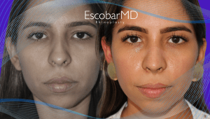 Before After Ethnic Rhinoplasty in Dubai 6 CLOSED ETHNIC RHINOPLASTY