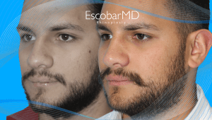 Before After Male Rhinoplasty in Dubai 11 Case 21 Scarless Rhinoplasty in Men
