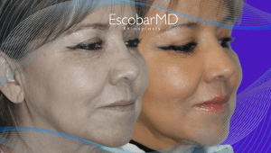 Before After Revision Rhinoplasty in Dubai 11 Case 22 Closed Revision Rhinoplasty Dr Escobar Dubai