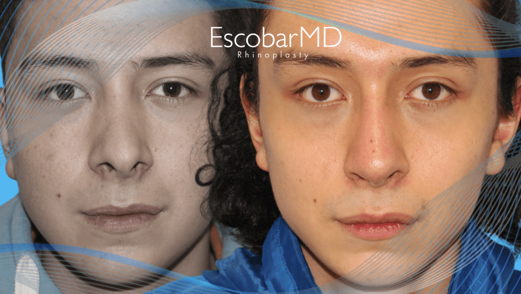 Rhinoplasty in Men Dubai with Dr. Escobar 9 Case 23 Closed Revision Rhinoplasty Dr Escobar Dubai