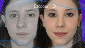Before After Closed Rhinoplasty in Dubai 2 DEVIATED NOSE (2)