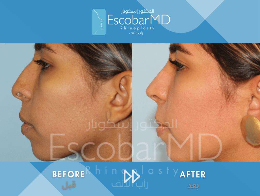 Closed Ethnic Rhinoplasty in Dubai 1 Ethnic Closed Rhinoplasty Dr Escobar UAE (1)