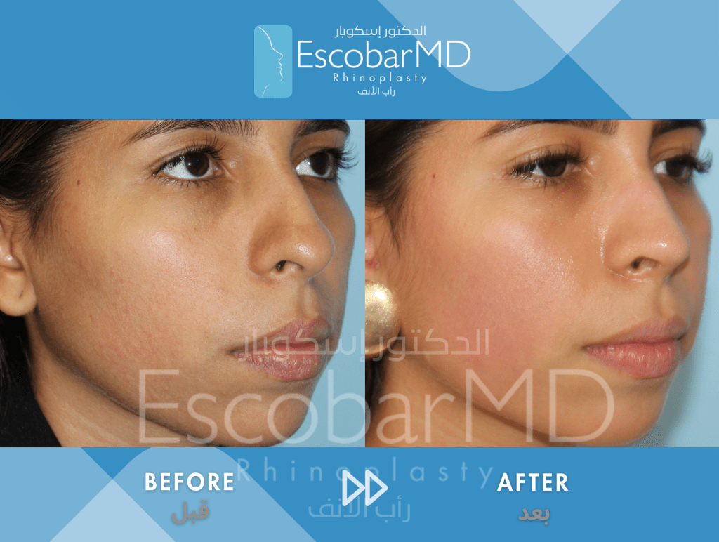 Closed Ethnic Rhinoplasty in Dubai 3 Ethnic Closed Rhinoplasty Dr Escobar UAE (2)