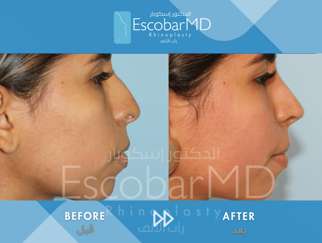 Closed Ethnic Rhinoplasty in Dubai 5 Ethnic Closed Rhinoplasty Dr Escobar UAE (3)