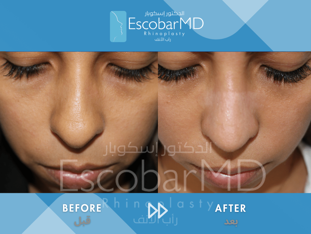 Closed Ethnic Rhinoplasty in Dubai 7 Ethnic Closed Rhinoplasty Dr Escobar UAE (4)
