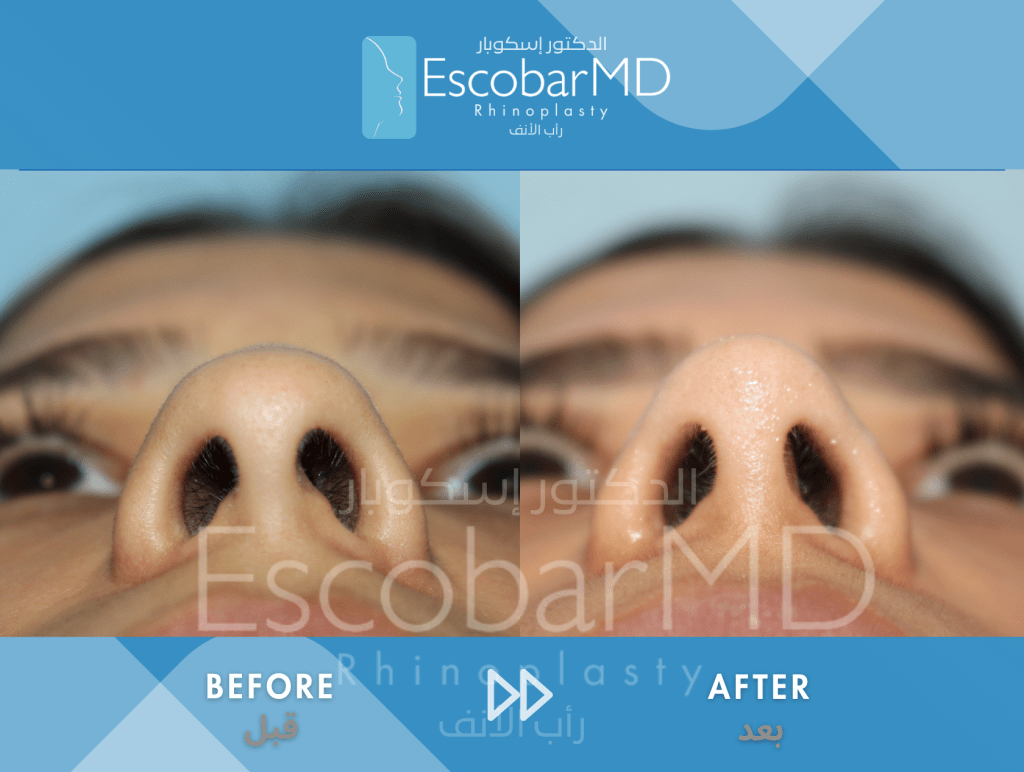 Closed Ethnic Rhinoplasty in Dubai 6 Ethnic Closed Rhinoplasty Dr Escobar UAE (5)