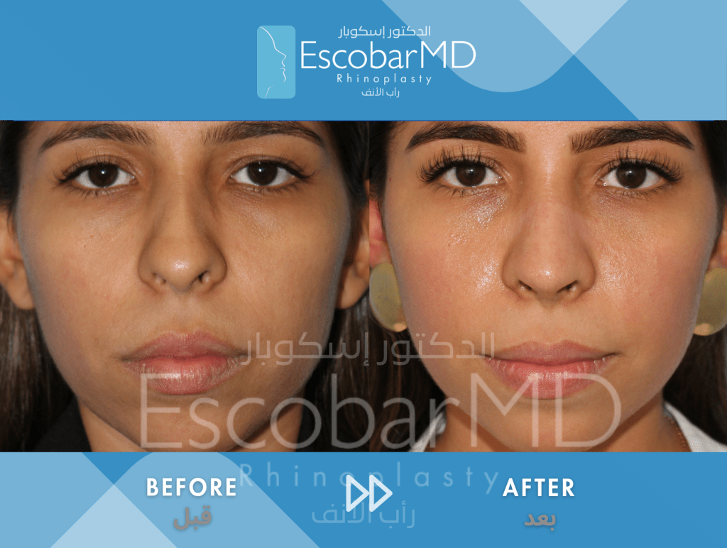 Closed Ethnic Rhinoplasty in Dubai 2 Ethnic Closed Rhinoplasty Dr Escobar UAE (6)