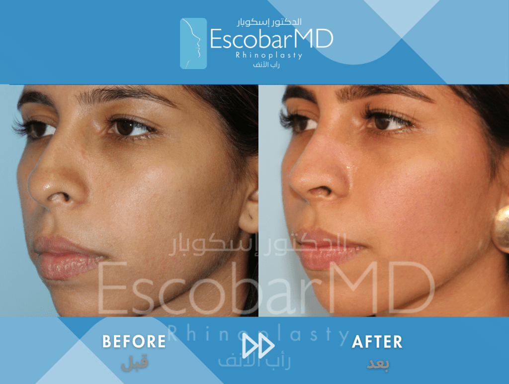 Closed Ethnic Rhinoplasty in Dubai 4 Ethnic Closed Rhinoplasty Dr Escobar UAE (7)