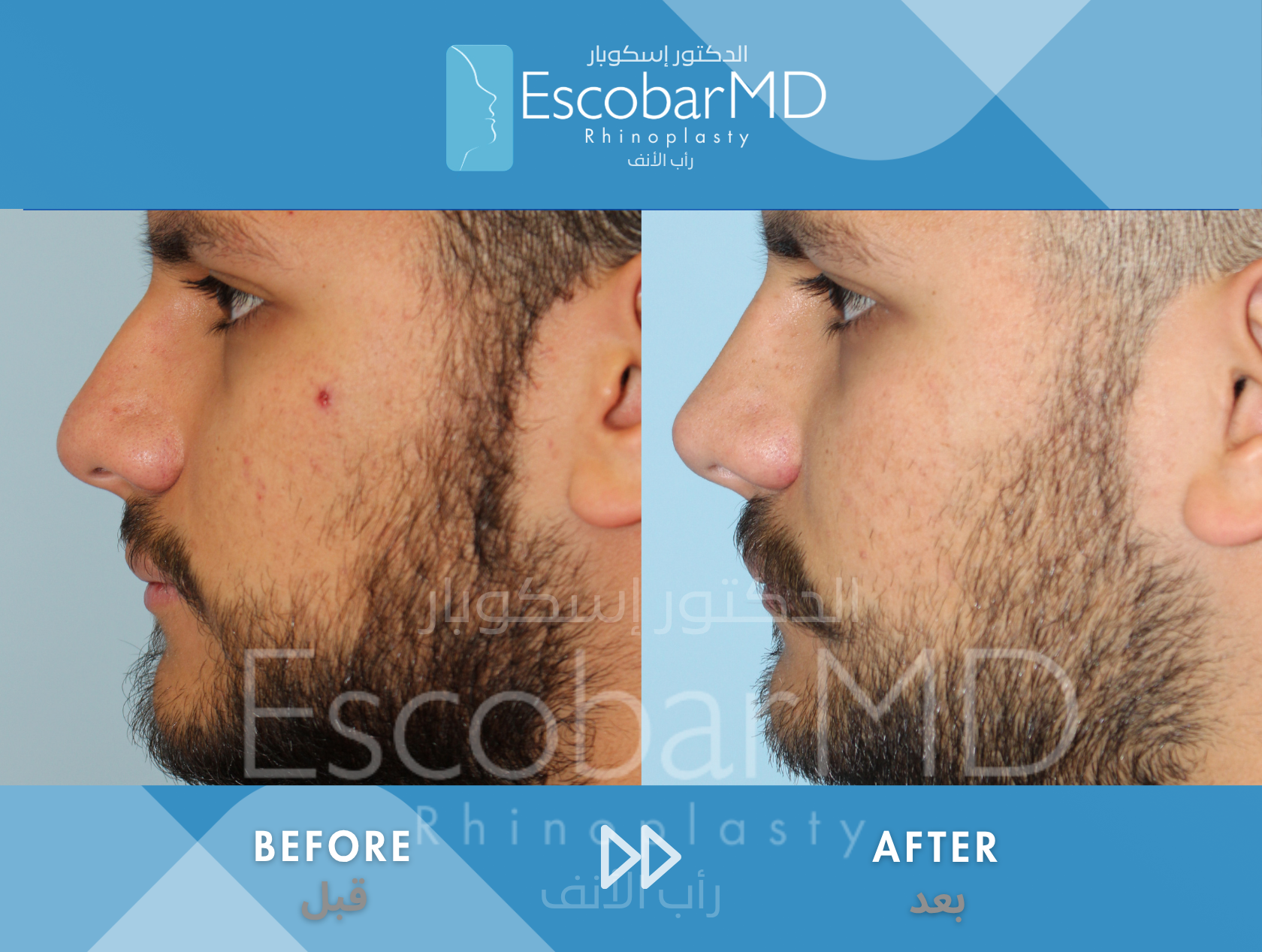 Male rhinoplasty Thick Skin Dr Escobar UAE (3)