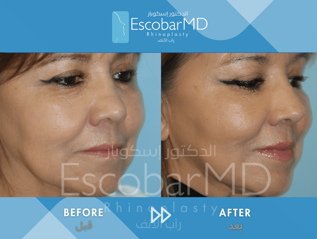 Closed Revision Rhinoplasty in Dubai 5 Structural Revision Rhinoplasty Dr Escobar UAE (5)